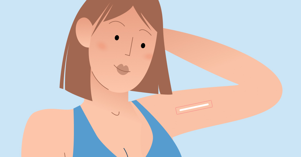 icd 10 code for complication of birth control implant in arm